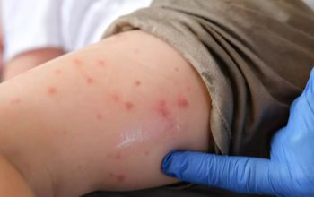 Sarampión en México